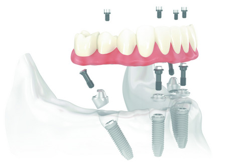 Diagram of All on 4 Treatment Concept