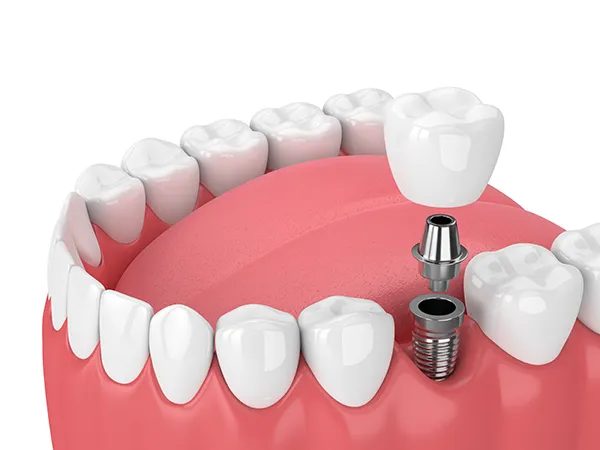 3D rendering of a dental implant and its components (screw, abutment, and crown) being placed into the jaw