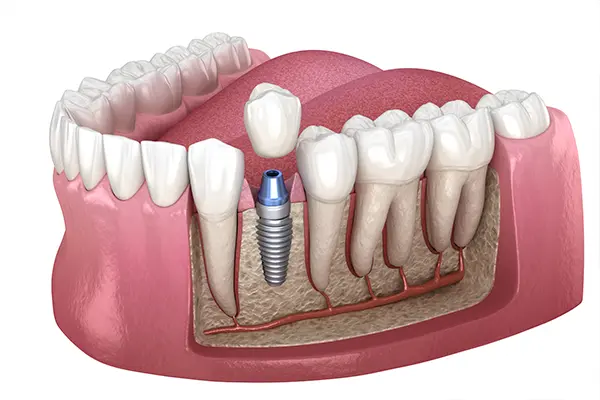 A cross-section of a dental implant integrated into the jawbone, surrounded by natural teeth, illustrating its structure and stability.